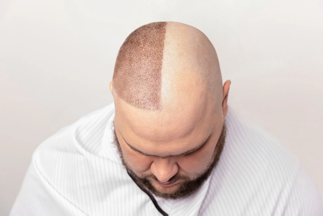 Hårtransplantation